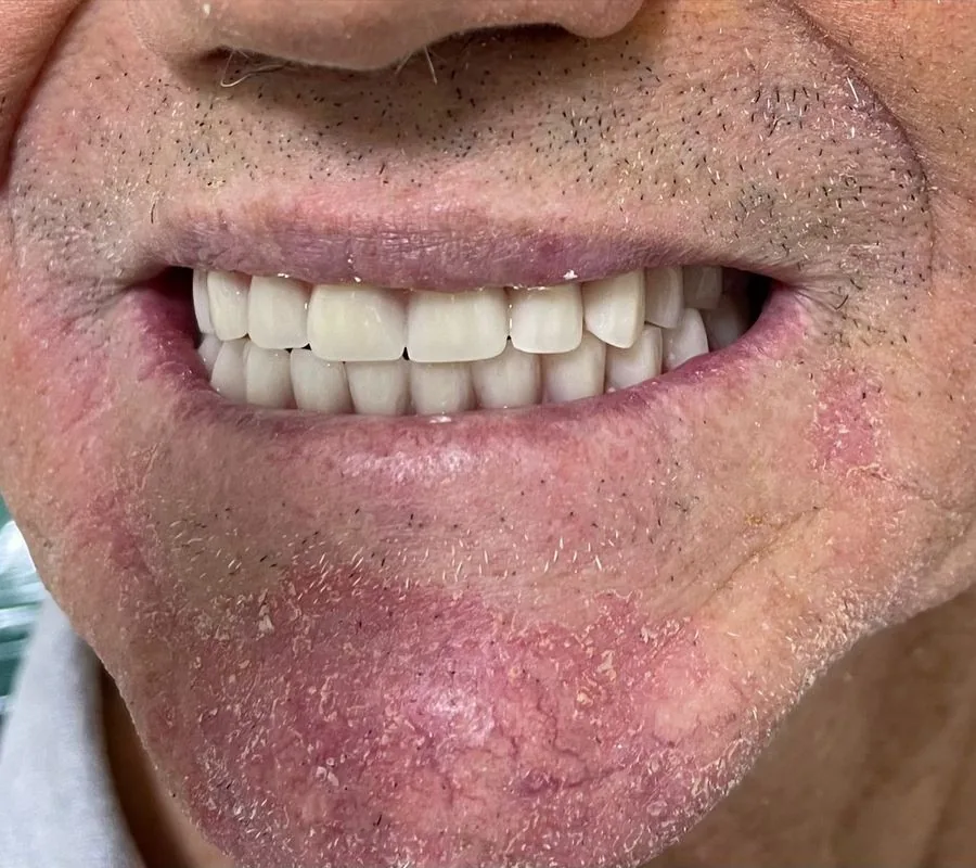 Paciente antes da reabilitação dental completa
