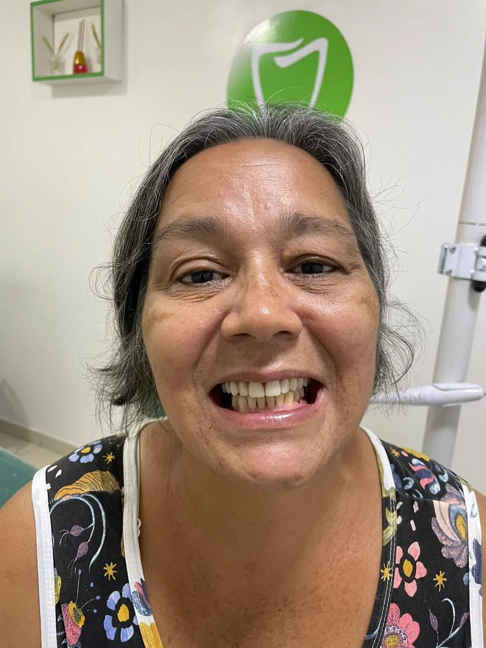 Paciente antes dos implantes dentários