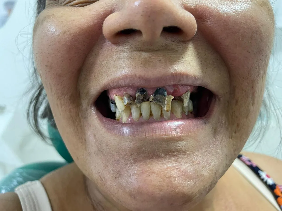 Mesmo paciente após implantes dentários
