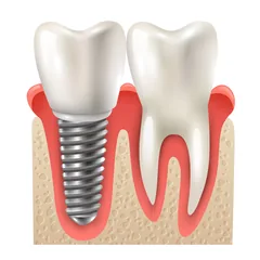 Implantes Dentários em Hortolândia