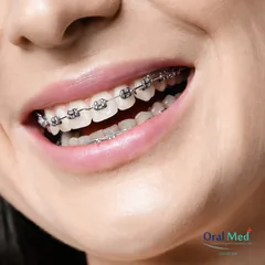 Aparelho Dentário e Ortodontia em Hortolândia